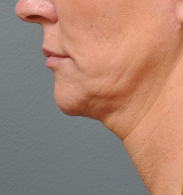 NON-SURGICAL FACE LIFT - Patient 1 - Before NON-SURGICAL FACE LIFT - Patient 1 - Before
